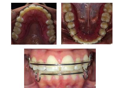 Estudios radiográficos de inicio (Figura 8) en la radiografía panorámica se pueden ver los 32 dientes presentes y que están en formación los gérmenes dentarios de los terceros molares.