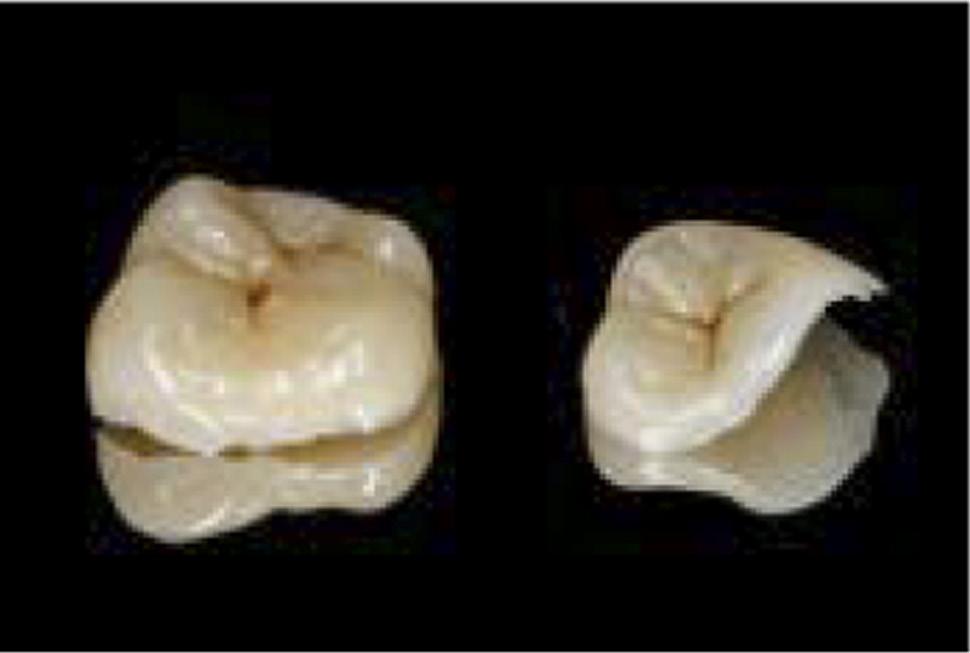 Módulo IV 21-22 Junio Reconstrucción del diente endodonciado en el sector posterior.