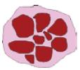 3.1.Lesión no melanocítica (2º etapa): 3.1.3 Hemangioma: - Lagunas rojas o rojo azuladas.