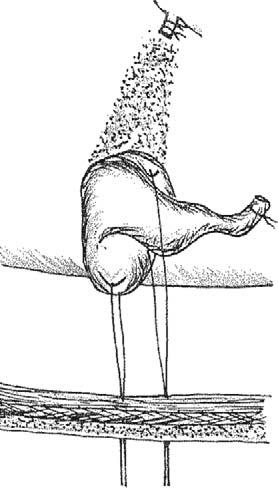 Dr. Vargas Fig. 6. Tracción de la vesícula contra la pared abdominal y colocación apropiada de cístico para mayor exposición. Fig. 5.