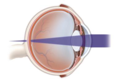 Tratamientos Miopía La cirugía refractiva se encarga de corregir los problemas de miopía, hipermetropía y astigmatismo.
