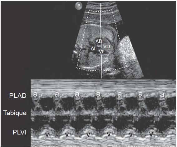 Formas de evaluación en el feto Modo M Corte 4 cámaras Haz de US a través de pared auricular y ventricular, sobre unión AVà aurícula derecha y Ventrículo