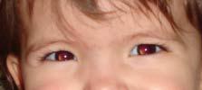 4.- Inspección ocular Reflejo rojo de fondo Técnica Oftalmoscopio directo enfocado a pupila A 1 brazo de