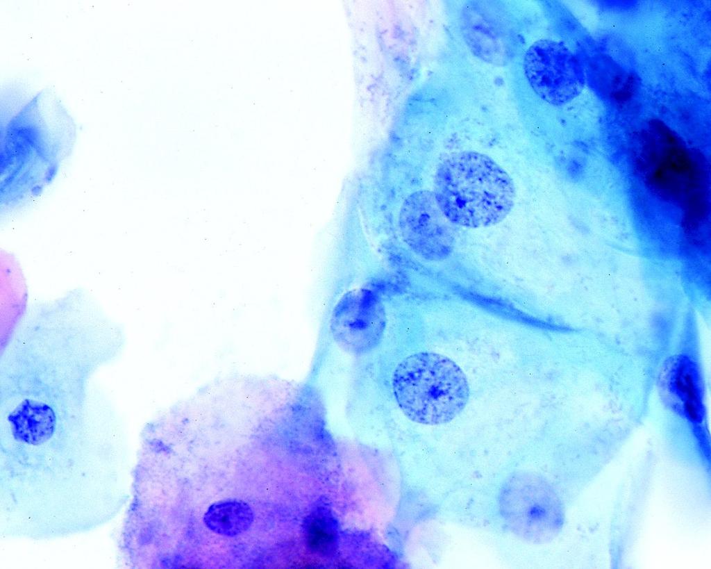 CAMBIOS REACTIVOS BENIGNOS DEL EPITELIO ThinPrep; 40 x Historia clínica: screening de rutina presencia de células escamosas; con núcleo grande; la cromatina tiene una