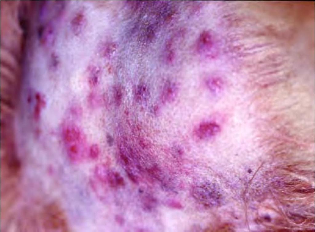 Neoplasias De la epidermis Papiloma Carcinoma de células escamosas De los anexos epidérmicos