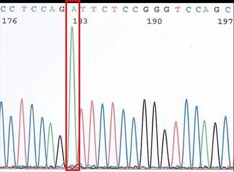 GTCCTCCTGGGAGACCAG Samples Mutation COL4A5 gene: c.3722g>a, p.(g1241d) hemizygous Synonymous change (polymorphism) = c.