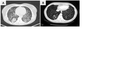 41 Figura 2: Figura 2. Imágenes de TC torácico representativas en el momento del diagnóstico (noviembre 2011, Fig.