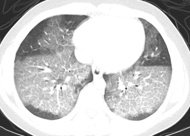 pulmonar (a, b, c y