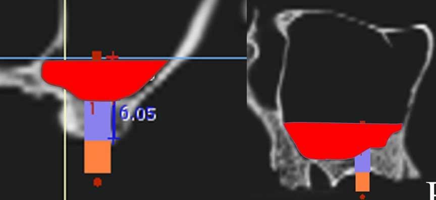 MORAES, P. H.; COSTA, V. O. C.; OLATE, S.; CARIA, P. H. F. & BARBOSA, J. R. A. Estudio morfométrico del seno maxilar mediante tomografías computadorizadas. Evaluación de la Fig. 4.