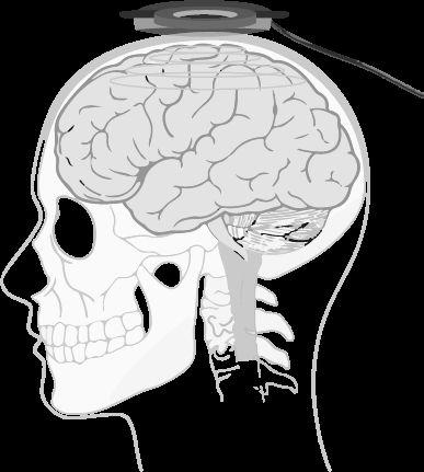 QUÉ ES LA TMS? La estimulación magnética transcraneal (TMS por sus siglas en inglés: Transcranial Magnetic Stimulation) es una técnica electromagnética diseñada para estimular la corteza cerebral [1].