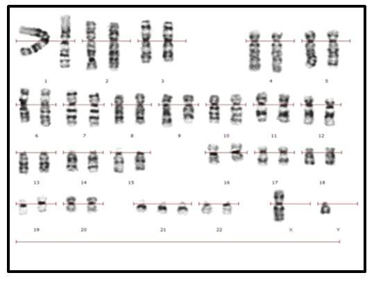 Figura 8: Cariotipo de un paciente con Leucemia Mieloide Crónica (LMC) donde se señala la translocación entre los cromosoma 9 y 22, el cromosoma 22 o cromosoma Filadelfia.