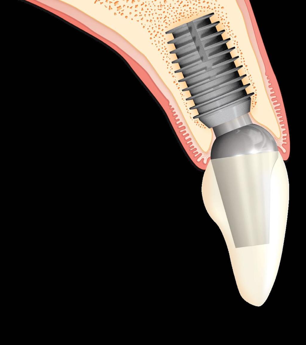 El diseño de aleta del implante proporciona hueso de tipo cortical con sistemas vasculares centrales alrededor de la superficie implantaria.