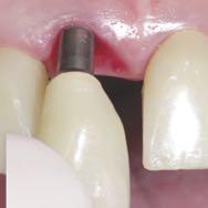 El IAC proporciona al dentista estética subgingival garantizada en cada restauración, sin ningún esfuerzo o gasto extra por parte del dentista o técnico. SELLADO CÓNICO DE 1.