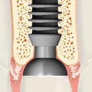 El sellado bacteriano de Bicon evita infiltraciones microbianas que pueden provocar una inflamación del tejido blando alrededor del implante, lo cual podría ocasionar una pérdida de hueso alrededor