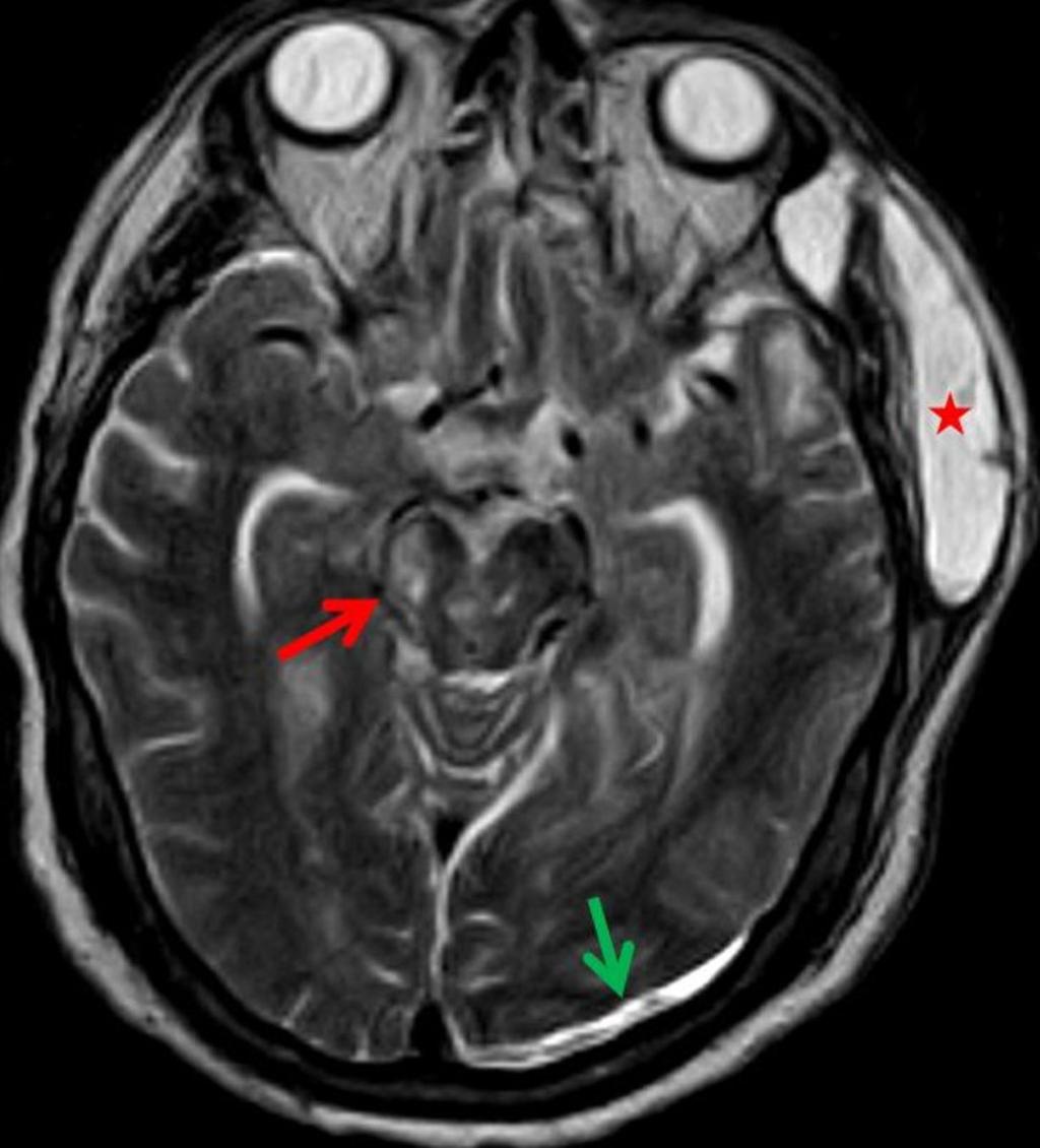 Fig. 5: Corte axial del cráneo en secuencia TSE potenciada en pt2, que ilustra los cambios postquiurgicos (asterisco) y