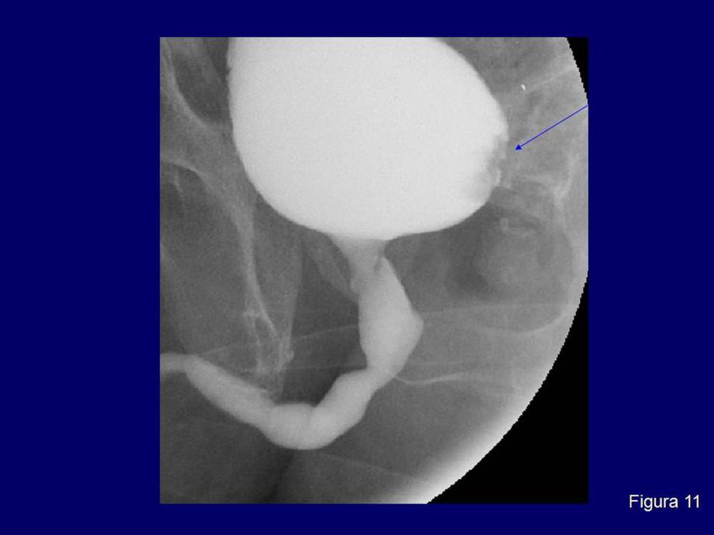 Fig. 11: Defecto de repleción irregular en la pared izquierda de vejiga por carcinoma urotelial