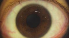 anterior del ojo Escopio del segmento anterior del
