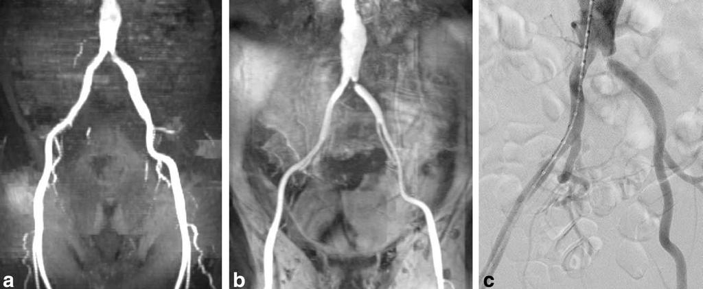 Aorto iliaco: Sensibilidad 80-88% Espec: 73-92%* ARM sin conraste ARM con gadolinio Arteriografia DSA *Comparison of Contrast Enhanced ME