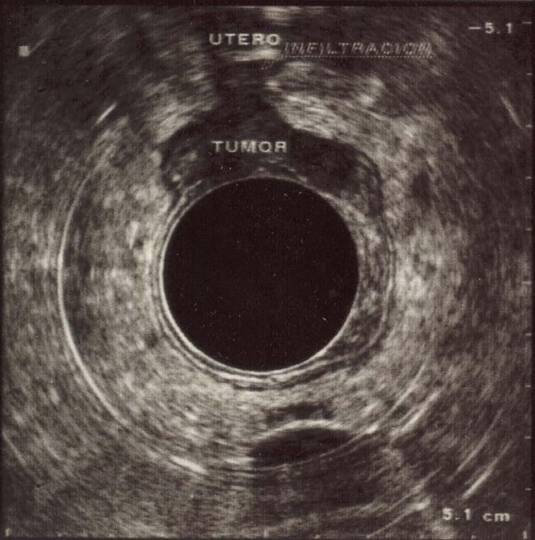 ut4: Tumor que invade la fascia mesorrectal y otros órganos o estructuras adyacentes (Ilustración 13). Ilustración 13. Tumor que infiltra el útero (ut4).