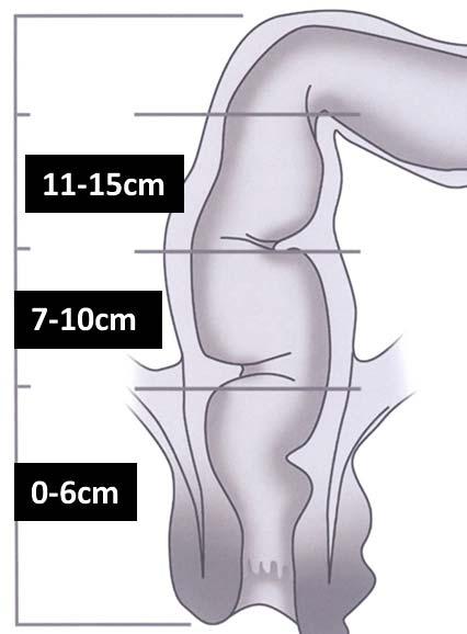 Ilustración 7. Localización de los tumores rectales. Tercio inferior, medio y superior. 3.5.3.2. Tacto rectal.