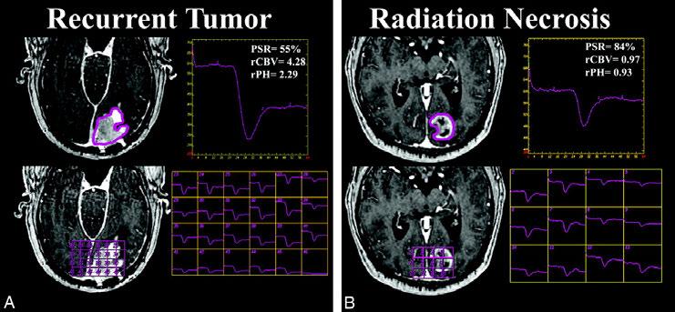 Distinguishing Recurrent Intra-Axial Metastatic Tumor from Radiation Necrosis Following Gamma Knife