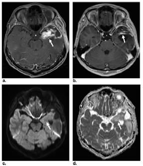 Diffusion-weighted MR Imaging for the Differentiation of True Progression from Pseudoprogression Following