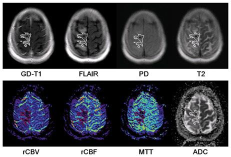 Support Vector Machine (SVM) Multiparametric MRI Identification of Pseudoprogression from