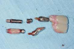 retirar los implantes y las