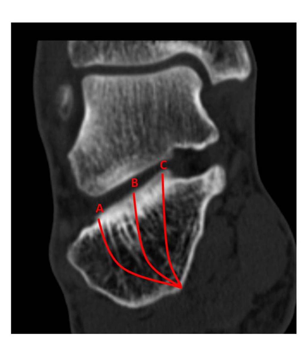Fig. 7: Subtipos de fractura según la posición de la línea de fractura. Imagen coronal de calcáneo.