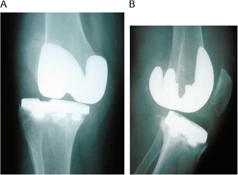 La prótesis total de rodilla inestable 115 en flexión, y considerar significativa si la separación de los extremos articulares es mayor de 10 mm; también hay que buscar una posible laxitud