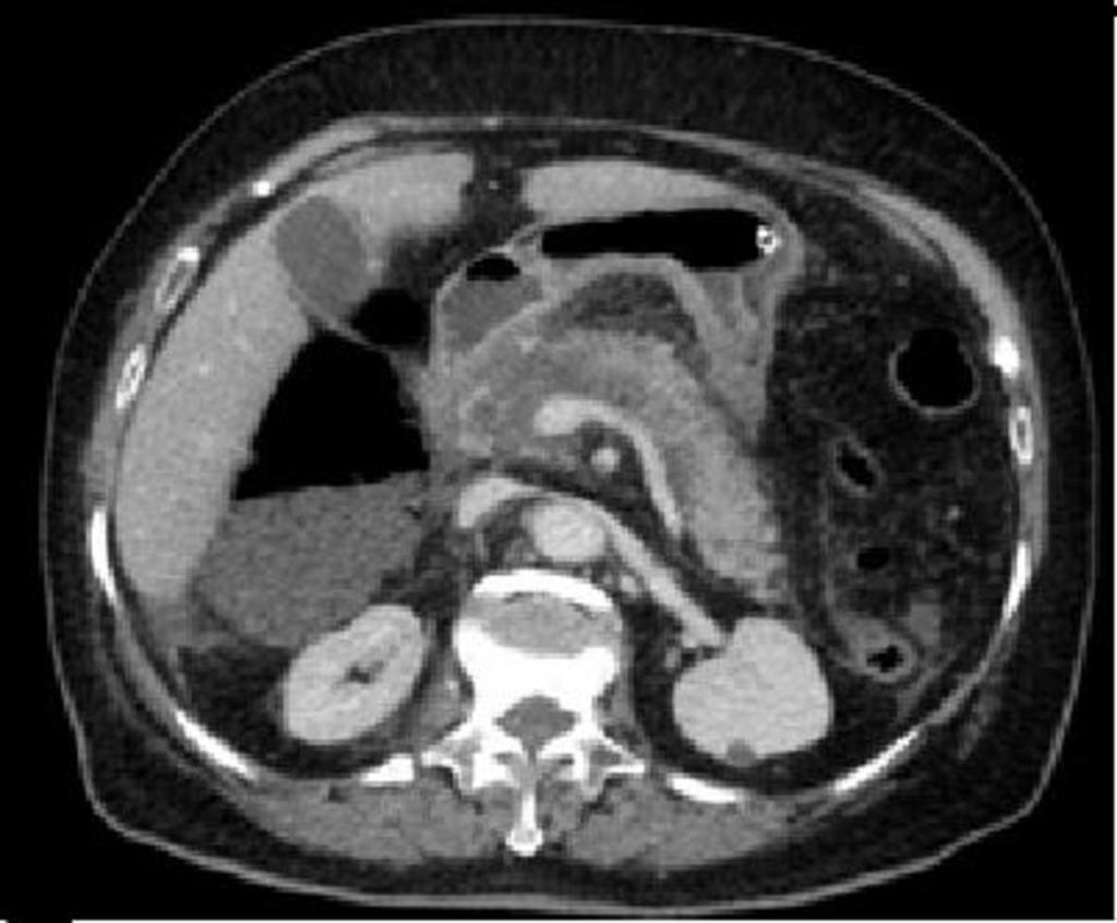 Fig. 5: Corte axial de TC abdominal con CIV en paciente con pancreatitis necrotizante aguda donde se observan