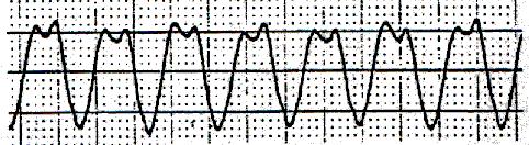 Tratamiento Trazo de un EKG de una paciente de