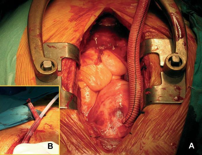 en 4 años Se debería considerar al tratamiento intervencionista : aorta excede los 55 a 60 mm, dolor