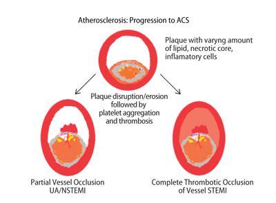 thrombus: pathophysiology and consequences