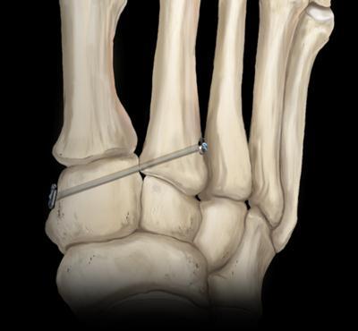 Tobillo y Pie LISFRANC CON MINI TIGHROPE El tratamiento exitoso de las lesiones de la articulación de Lisfranc incluye lograr y mantener