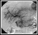 Colo-rectal mets Progressive to Surgery & FOLFOX Fase Arterial Fase Post TACE TCMD Base Portal 3m follow up RMI Base Fase Arterial Post arterial RMI RMI Base Fase Arterial Post arterial RMI 0,87x10-3