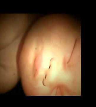 Una bebé iba a ser abortada, por malformaciones y parálisis cerebral por culpa de una burbuja de aire