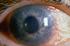 Glaucoma: Preguntas más Frecuentes