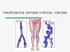insuficiencia venosa crónica: varices