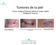 Tumores de la piel. Tumor maligno Párpado inferior/ Lower eyelid Malignant Tumour