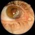 Tratamiento farmacológico de la neoplasia corneal y conjuntival
