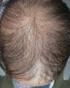 Alopecia areata incógnita