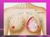 Resumen sobre el cáncer de seno (mama)