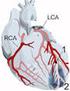 Infarto Agudo de Miocardio (Ataque al Corazón) Serie de Educación de Paciente MU