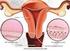 Guía educativa acerca del VPH y el cáncer cervicouterino