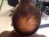 ALOPECIA ANDROGÉNICA