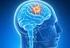 Tendencias futuras en el tratamiento de tumores cerebrales