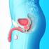 6. Cáncer de próstata diseminado