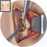 Tratamiento quirúrgico de la hernia discal lumbar! J.Olabe 2013