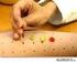 Metodología diagnóstica en la alergia a los alimentos